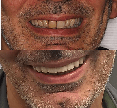 facettes dentaires avant après