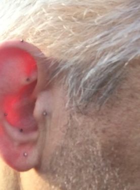 Acupuncture de l'oreille