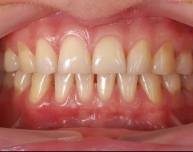 curetage dentaire pour des gencives saines