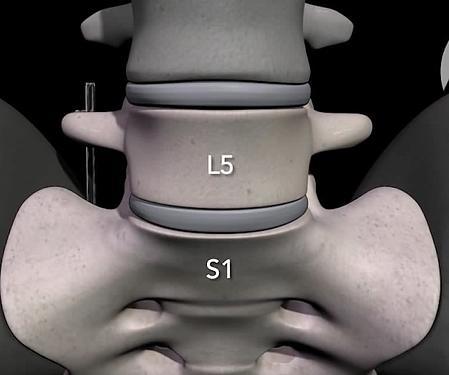 l5-s1 vertebral disc