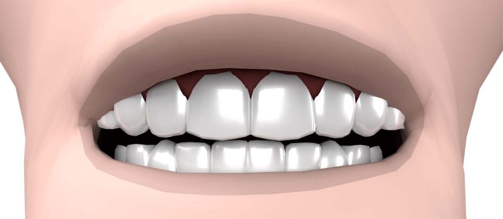 facettes dentaires avis emax cerec ou labo