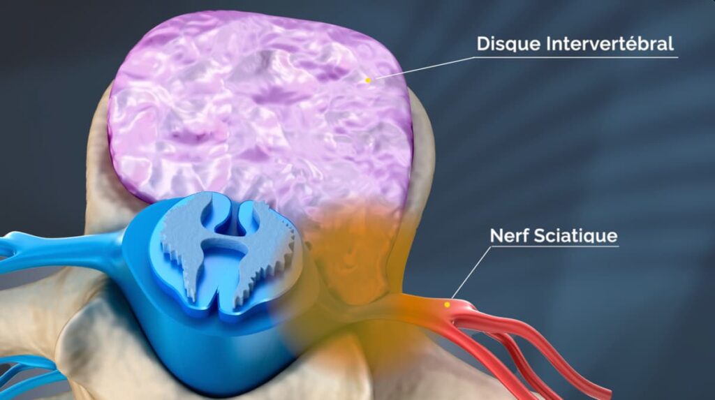 Disc applying pressure on sciatic nerve