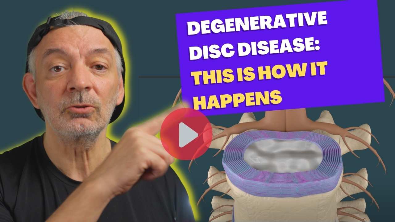 Degenerative disc disease - This is how it happens